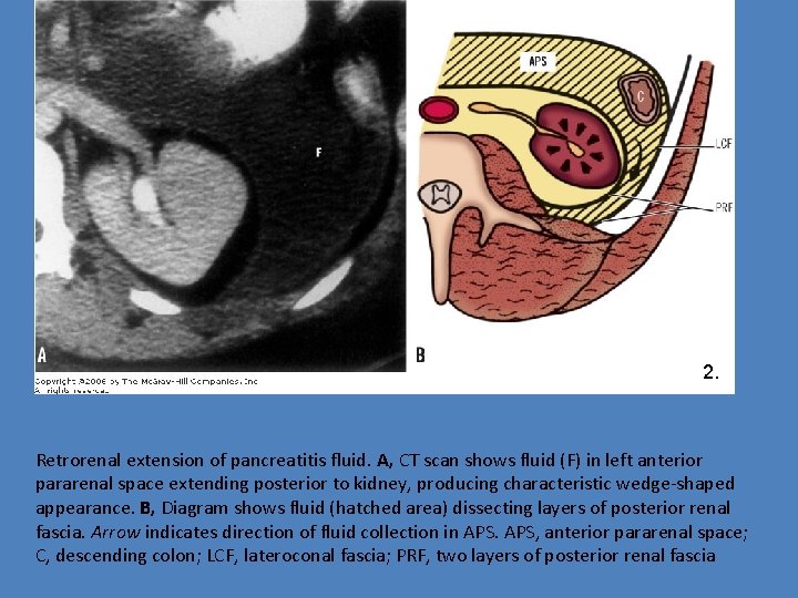2. Retrorenal extension of pancreatitis fluid. A, CT scan shows fluid (F) in left
