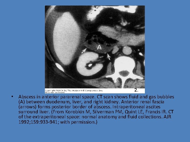 2. • Abscess in anterior pararenal space. CT scan shows fluid and gas bubbles