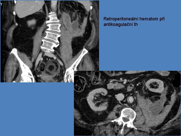 Retroperitoneální hematom při antikoagulační th 