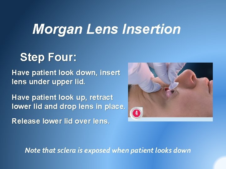 Morgan Lens Insertion Step Four: Have patient look down, insert lens under upper lid.