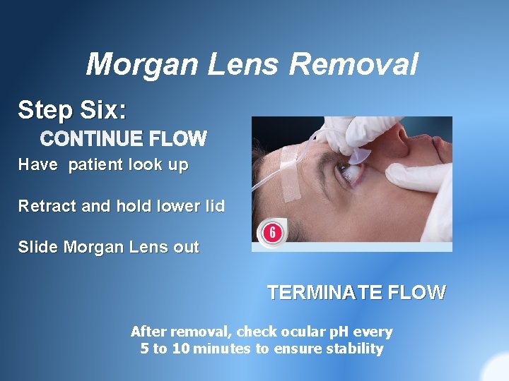 Morgan Lens Removal Step Six: CONTINUE FLOW Have patient look up Retract and hold