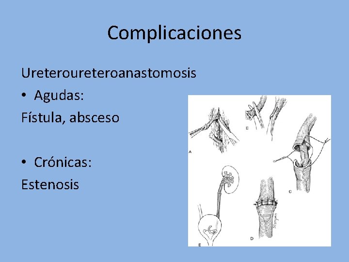 Complicaciones Ureteroureteroanastomosis • Agudas: Fístula, absceso • Crónicas: Estenosis 