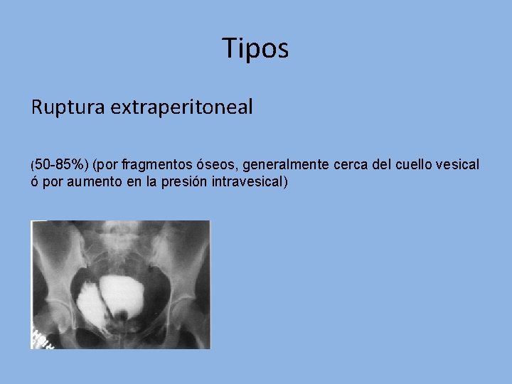 Tipos Ruptura extraperitoneal (50 -85%) (por fragmentos óseos, generalmente cerca del cuello vesical ó