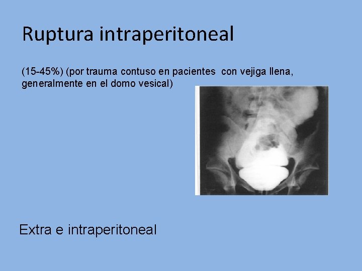Ruptura intraperitoneal (15 -45%) (por trauma contuso en pacientes con vejiga llena, generalmente en