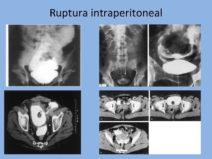 Ruptura intraperitoneal 