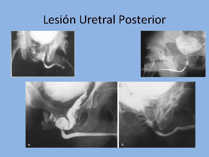 Lesión Uretral Posterior 