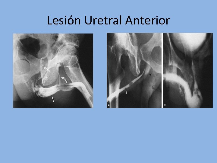 Lesión Uretral Anterior 