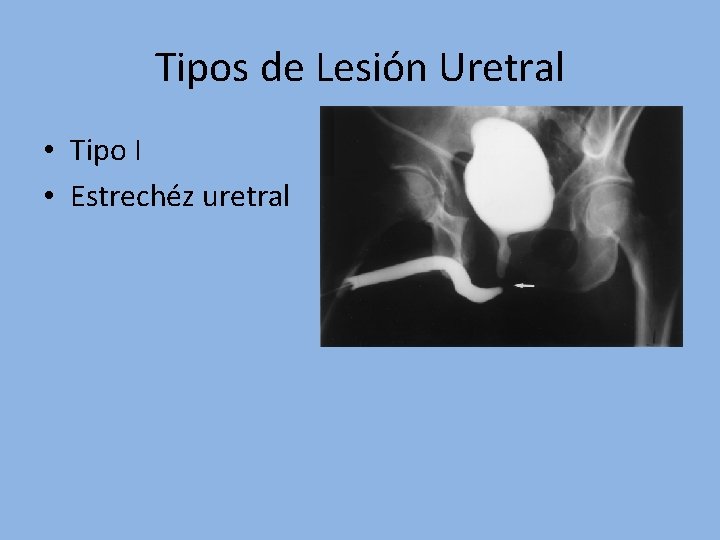 Tipos de Lesión Uretral • Tipo I • Estrechéz uretral 