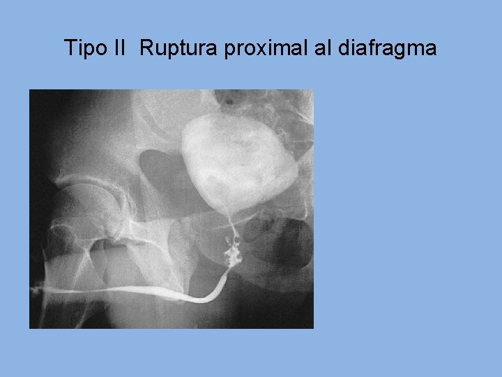 Tipo II Ruptura proximal al diafragma 