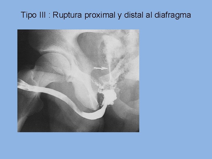 Tipo III : Ruptura proximal y distal al diafragma 