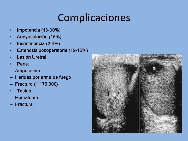 Complicaciones • Impotencia (13 -30%) • Aneyaculación (15%) • Incontinencia (2 -4%) • Estenosis