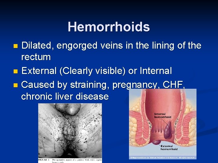 Hemorrhoids Dilated, engorged veins in the lining of the rectum n External (Clearly visible)