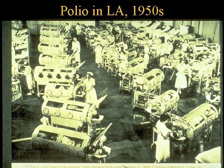 Polio in LA, 1950 s 