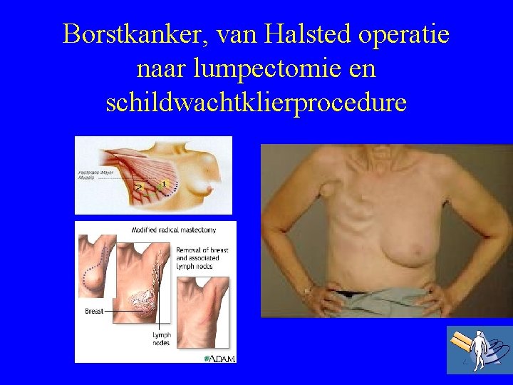 Borstkanker, van Halsted operatie naar lumpectomie en schildwachtklierprocedure 
