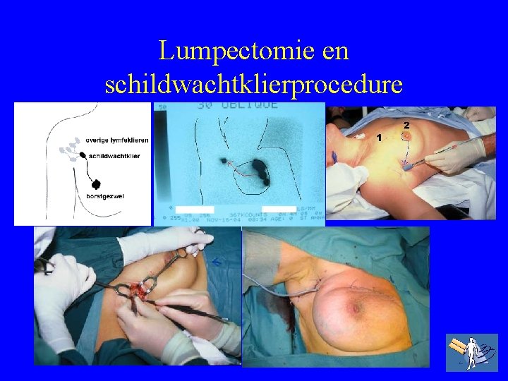 Lumpectomie en schildwachtklierprocedure 