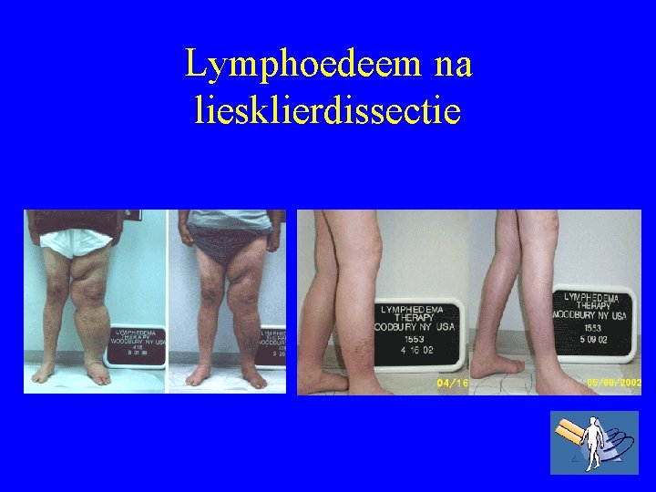 Lymphoedeem na liesklierdissectie 