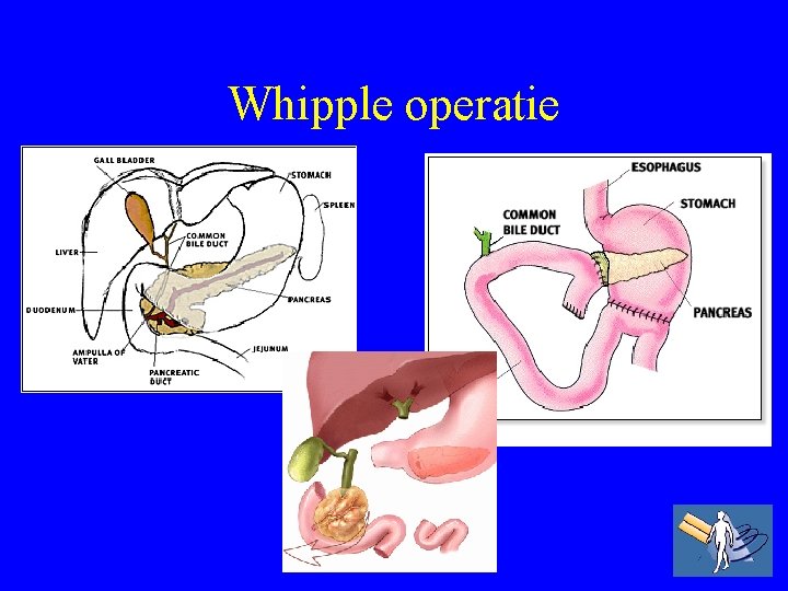 Whipple operatie 