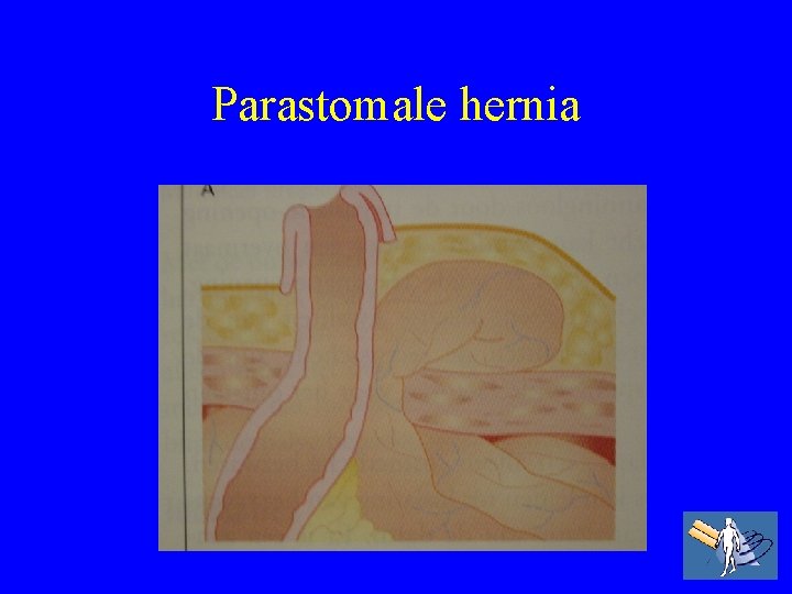 Parastomale hernia 