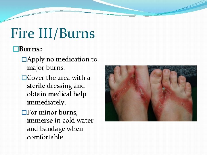 Fire III/Burns �Burns: �Apply no medication to major burns. �Cover the area with a