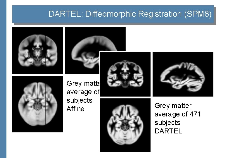 DARTEL: Diffeomorphic Registration (SPM 8) Grey matter average of 452 subjects Affine Grey matter