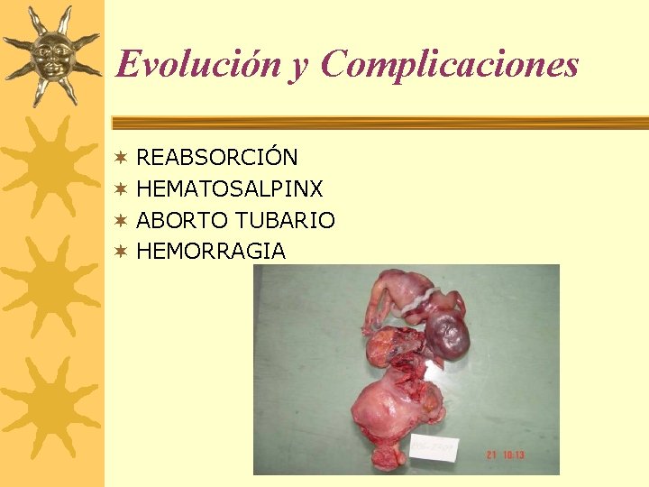 Evolución y Complicaciones ¬ REABSORCIÓN ¬ HEMATOSALPINX ¬ ABORTO TUBARIO ¬ HEMORRAGIA 