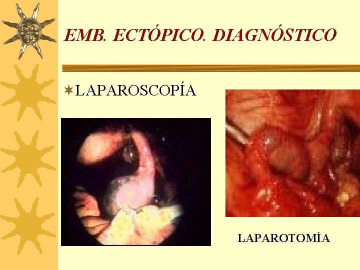 EMB. ECTÓPICO. DIAGNÓSTICO ¬LAPAROSCOPÍA LAPAROTOMÍA 