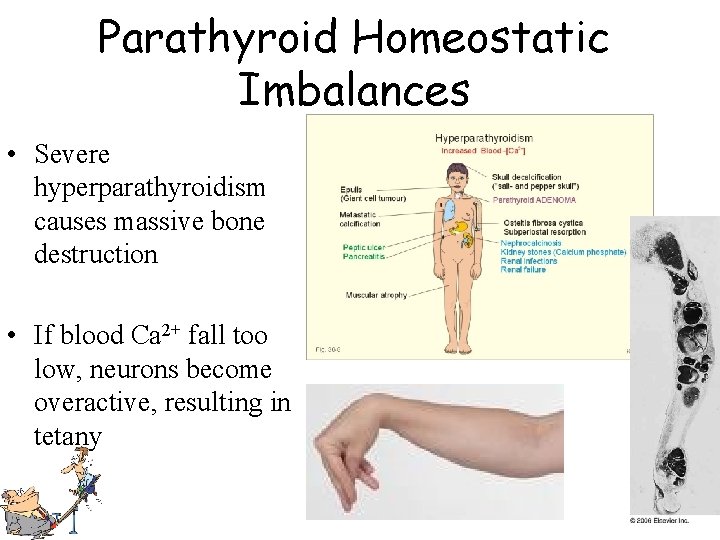 Parathyroid Homeostatic Imbalances • Severe hyperparathyroidism causes massive bone destruction • If blood Ca