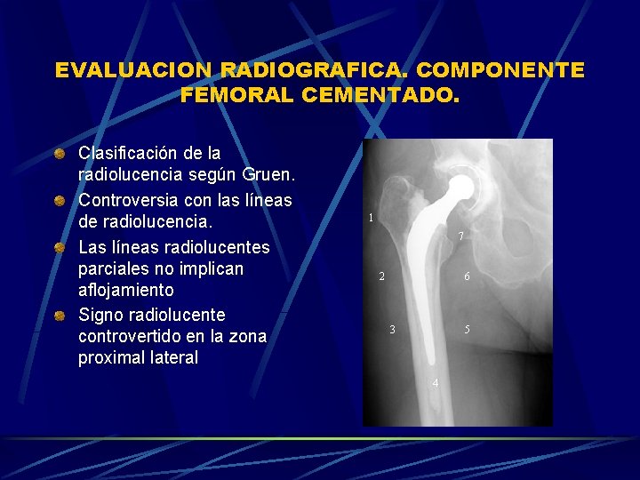 EVALUACION RADIOGRAFICA. COMPONENTE FEMORAL CEMENTADO. Clasificación de la radiolucencia según Gruen. Controversia con las