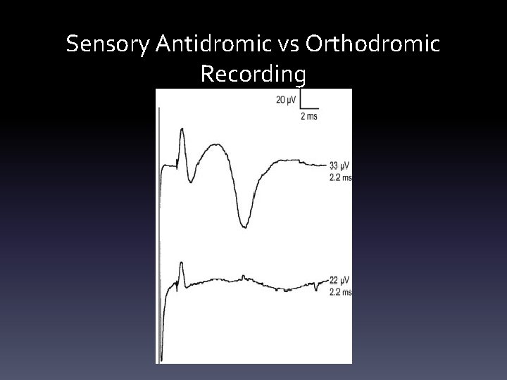 Sensory Antidromic vs Orthodromic Recording Sensory Antidromic vs Orthodromic Recording