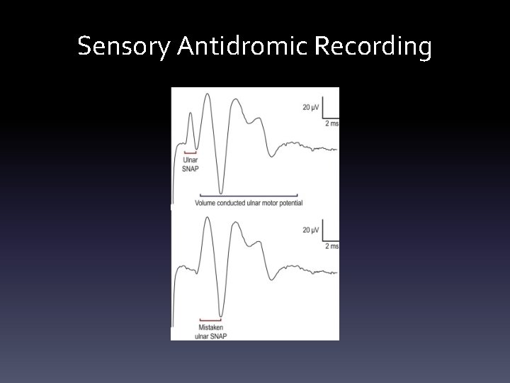 Sensory Antidromic Recording Sensory Antidromic Recording