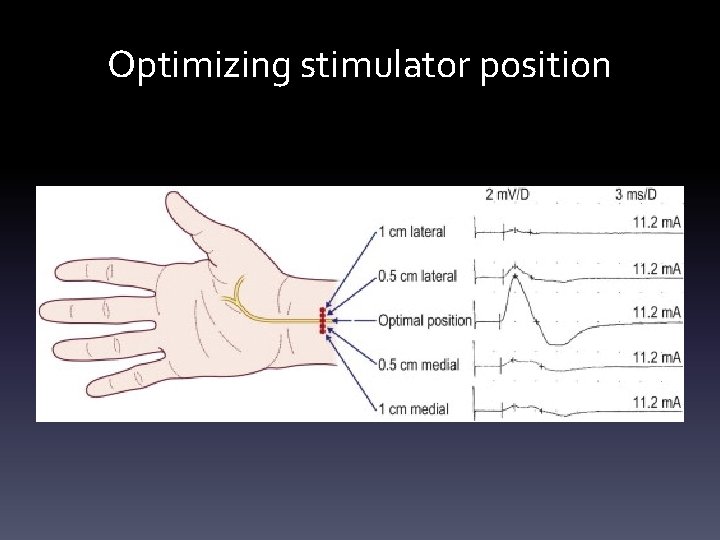 Optimizing stimulator position Optimizing stimulator position