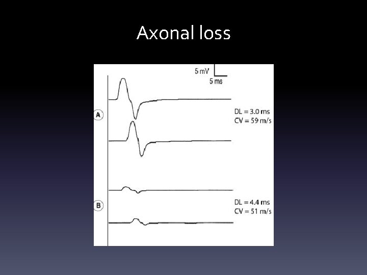 Axonal loss Axonal loss
