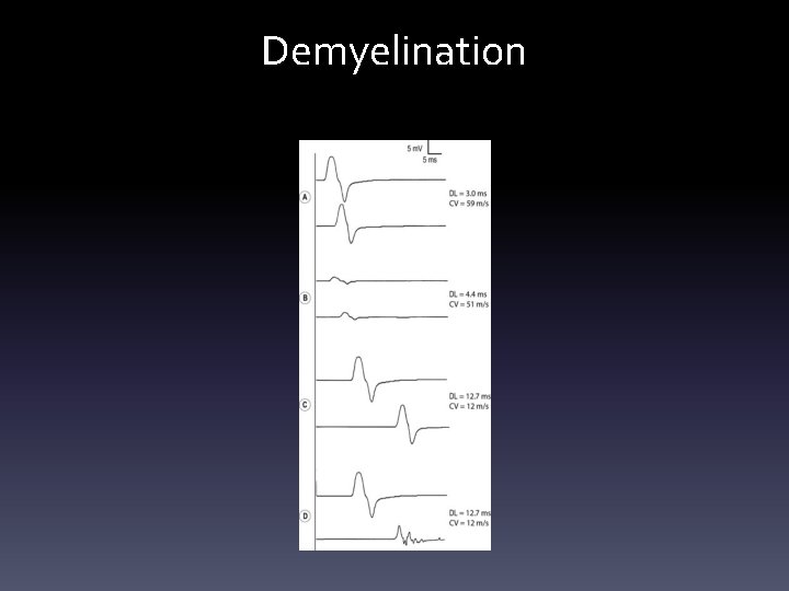 Demyelination Demyelination