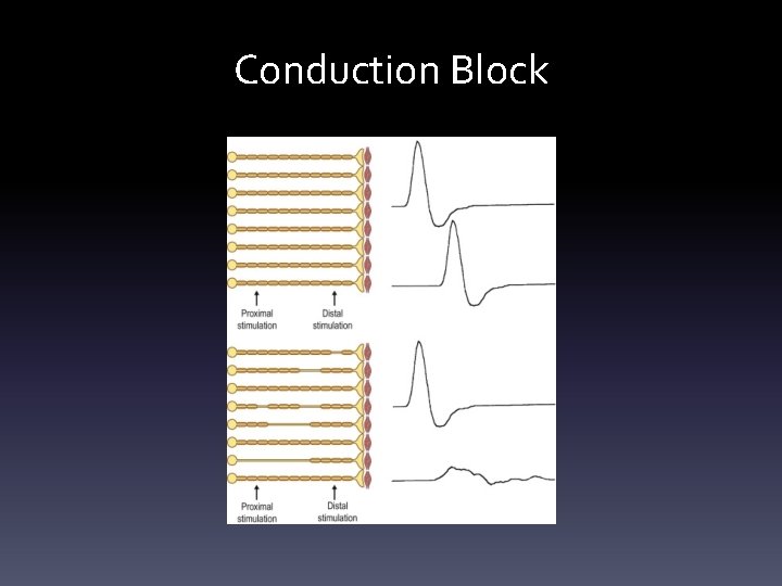 Conduction Block Conduction Block