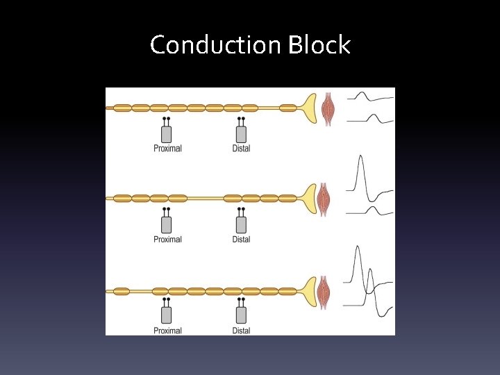 Conduction Block Conduction Block