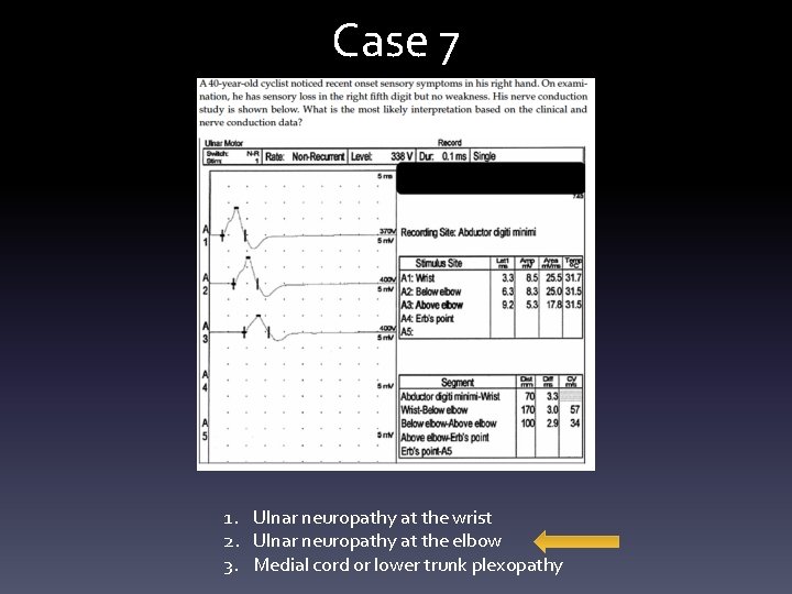 Case 7 1. Ulnar neuropathy at the wrist 2. Ulnar neuropathy at the elbow Case 7 1. Ulnar neuropathy at the wrist 2. Ulnar neuropathy at the elbow