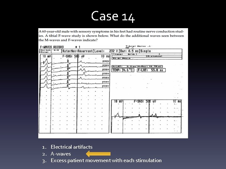 Case 14 1. Electrical artifacts 2. A-waves 3. Excess patient movement with each stimulation Case 14 1. Electrical artifacts 2. A-waves 3. Excess patient movement with each stimulation