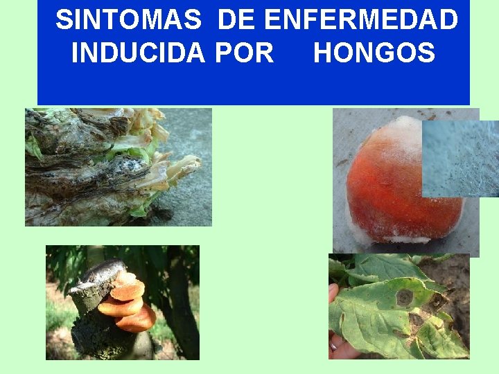 SINTOMAS DE ENFERMEDAD INDUCIDA POR HONGOS 