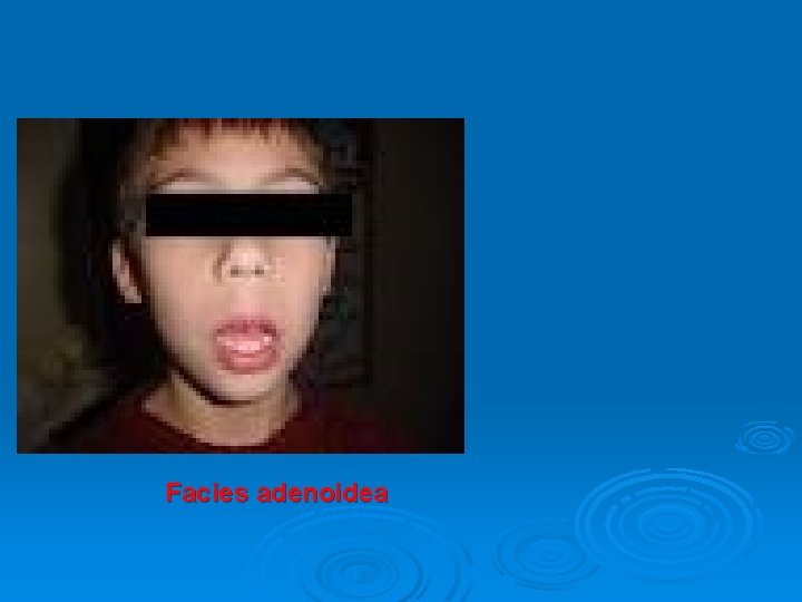 Facies adenoidea 
