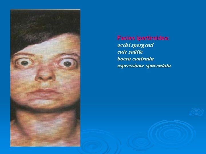 Facies ipertiroidea: occhi sporgenti cute sottile bocca contratta espressione spaventata facies 