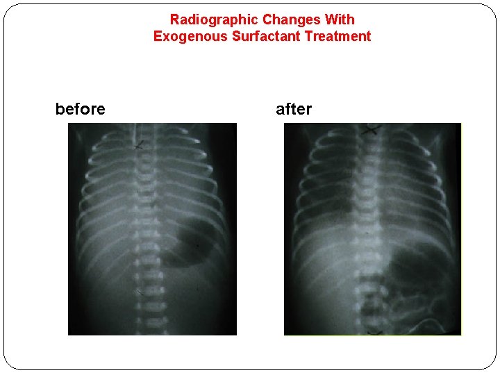 Radiographic Changes With Exogenous Surfactant Treatment before after 