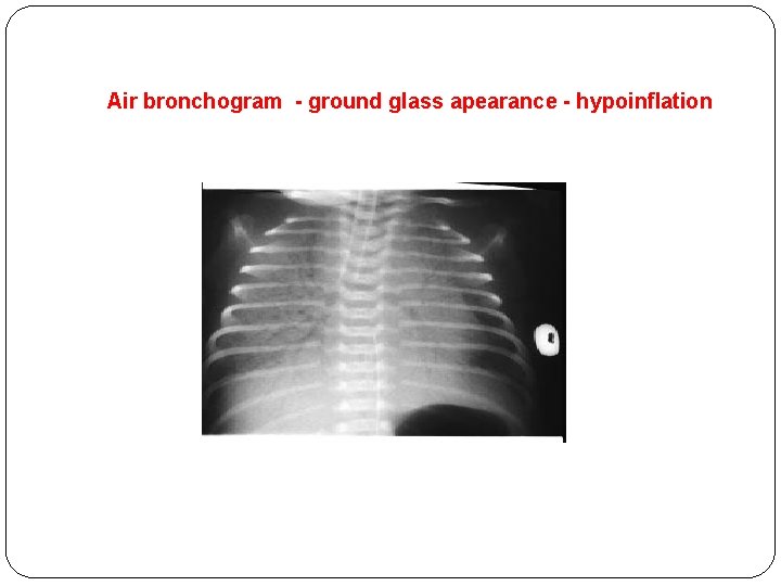 Air bronchogram - ground glass apearance - hypoinflation 