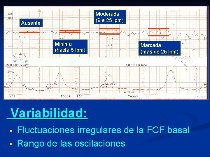 Moderada (6 a 25 lpm) Ausente Minima (hasta 5 lpm) Marcada (mas de 25