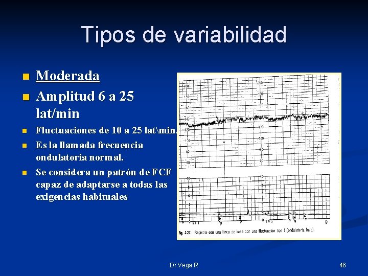 Tipos de variabilidad n n n Moderada Amplitud 6 a 25 lat/min Fluctuaciones de