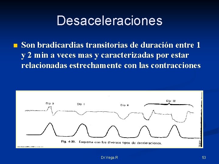 Desaceleraciones n Son bradicardias transitorias de duración entre 1 y 2 min a veces