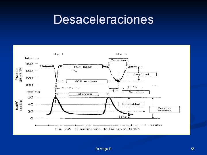 Desaceleraciones Dr. Vega. R 55 