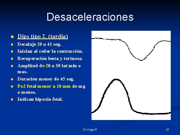 Desaceleraciones n Dips tipo 2. (tardia) n Decalaje 20 a 41 seg. Inician al