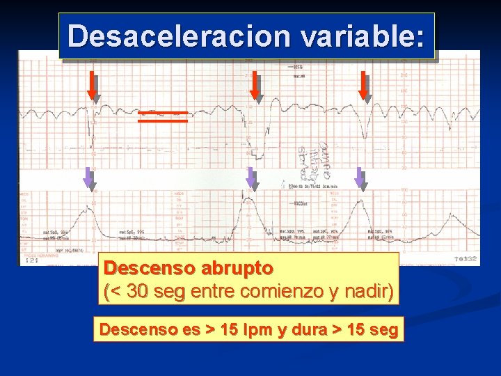 Desaceleracion variable: Descenso abrupto (< 30 seg entre comienzo y nadir) Descenso es >