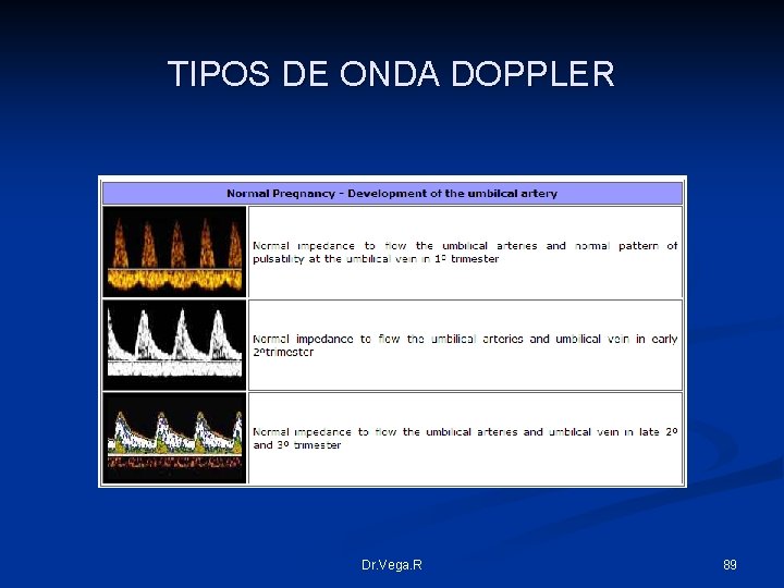 TIPOS DE ONDA DOPPLER Dr. Vega. R 89 