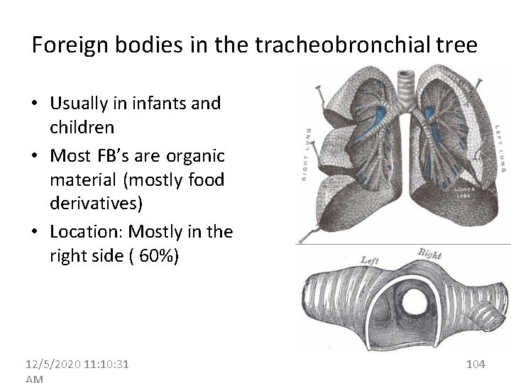 Foreign bodies in the tracheobronchial tree • Usually in infants and children • Most